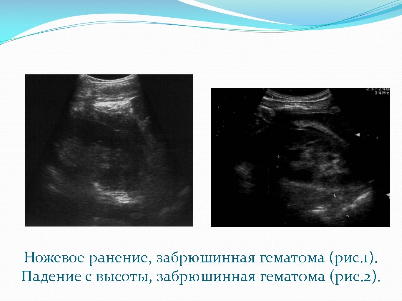 Ножевое ранение, забрюшинная гематома (рис.1). Падение с высоты, забрюшинная гематома (рис.2).
